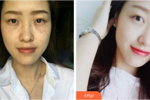 溫州同德醫(yī)院整形美容中心李冬梅整形價(jià)格表附祛斑案例展示