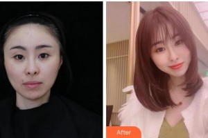 溫州東華醫(yī)院醫(yī)療美容科李營(yíng)整形價(jià)格表附膠原蛋白除皺案例展示