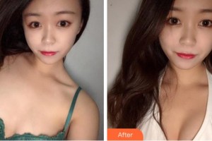 溫州解放軍118醫(yī)院整形科安伯忠整形價(jià)格表附自體脂肪隆胸案例展示