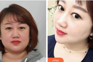 溫州藝美整形美容醫(yī)院金蓉整形價(jià)格表附眼部整形案例展示