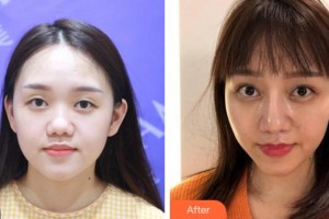 溫州藝美整形美容醫(yī)院顧斌整形價(jià)格表附眼部綜合案例展示