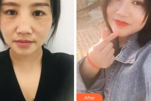 溫州韓美整形美容醫(yī)院紀(jì)強(qiáng)整形價(jià)格表附眼部綜合案例展示