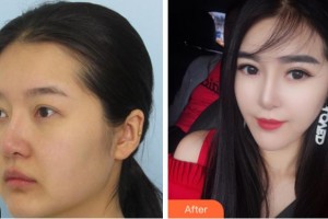 溫州藝美整形美容醫(yī)院徐莎整形價(jià)格表附眼部綜合案例展示