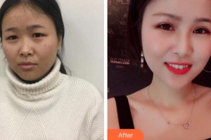 溫州韓美整形美容醫(yī)院周杰群整形價(jià)格表附眼部綜合案例展示