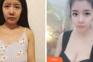 溫州韓美整形美容醫(yī)院邰守權(quán)整形價(jià)格表附隆胸案例展示