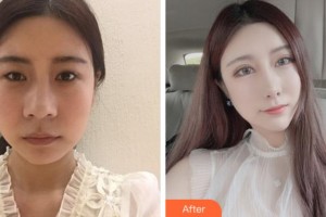 溫州韓星醫(yī)療美容門診部陳美香整形價(jià)格表附眼部綜合案例展示