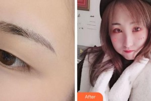 溫州藝星醫(yī)學(xué)美容醫(yī)院馬秀芬整形價(jià)格表附切開雙眼皮案例展示