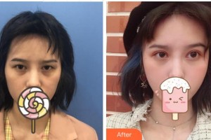 溫州東華醫(yī)院醫(yī)療美容科張群整形價(jià)格表附切開雙眼皮案例展示