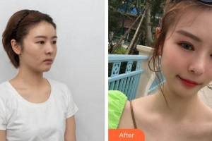 溫州東華醫(yī)院醫(yī)療美容科萬(wàn)志華整形價(jià)格表附眼部綜合案例展示