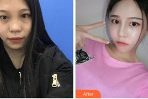 溫州東華醫(yī)院醫(yī)療美容科趙國(guó)錄整形價(jià)格表附埋線雙眼皮案例展示