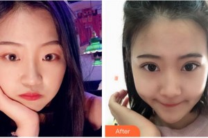 溫州星范醫(yī)學(xué)美容門診部應(yīng)天詳整形價(jià)格表附切開雙眼皮案例展示