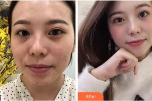 溫州芙萊拉醫(yī)療美容醫(yī)院胡彬整形價(jià)格表附激光去眼袋案例展示