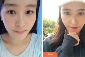 溫州芙萊拉醫(yī)療美容醫(yī)院但漢乾整形價(jià)格表附切開雙眼皮案例展示