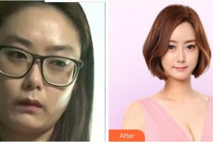 溫州藝星醫(yī)學(xué)美容醫(yī)院成浩整形價(jià)格表附內(nèi)切祛眼袋案例展示