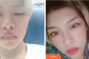 溫州佑康和平整形醫(yī)院陳炳偉整形價(jià)格表附切開雙眼皮案例展示