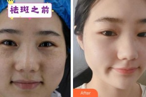 溫州上雅醫(yī)學(xué)美容門診部吳慧明整形價(jià)格表附激光祛斑案例展示