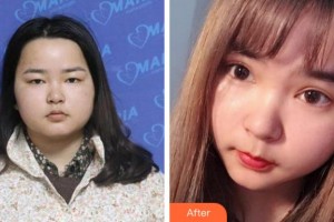 溫州佑康和平整形醫(yī)院蔡?hào)|亮整形價(jià)格表附切開雙眼皮案例展示