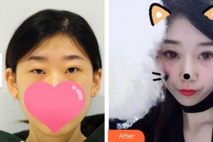 溫州藝星醫(yī)學(xué)美容醫(yī)院黃樂整形價(jià)格表附切開雙眼皮案例展示