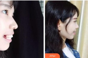 溫州牙科醫(yī)院鄭翔整形價(jià)格表附隱形托槽矯正案例展示