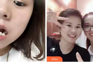 溫州市中西醫(yī)結(jié)合醫(yī)院醫(yī)學(xué)美容中心柯友輝整形價(jià)格表附牙齒陶瓷矯正案例展示