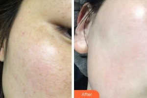 溫州市人民醫(yī)院整形外科周建敏整形價(jià)格表附光子嫩膚案例展示