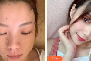 溫州伯思立醫(yī)院醫(yī)療美容科鄒仙娥整形價(jià)格表附埋線提升案例展示