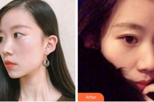 溫州伯思立醫(yī)院醫(yī)療美容科李茂群整形價(jià)格表附眼部綜合案例展示