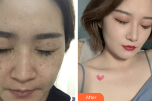 深圳西諾醫(yī)療美容門診部侯艷萍整形價格表附激光祛斑案例展示