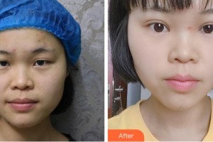 溫州伯思立醫(yī)院醫(yī)療美容科周薇整形價(jià)格表附切開雙眼皮案例展示