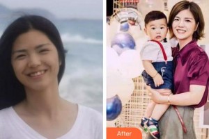 溫州醫(yī)科大學(xué)附屬口腔學(xué)院麻健豐整形價(jià)格表附牙齒隱形矯正案例展示