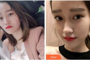 溫州醫(yī)科大學(xué)附屬口腔學(xué)院劉勁松整形價(jià)格表附牙齒隱形矯正案例展示