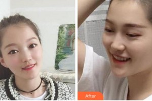 溫州醫(yī)科大學(xué)附屬口腔學(xué)院鄧輝整形價(jià)格表附金屬托槽矯正案例展示