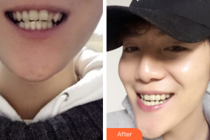 深圳易容顏醫(yī)療美容門診部王航整形價格表附隱適美隱形矯正案例展示