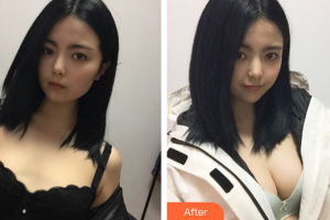 深圳易容顏醫(yī)療美容門診部劉金虎整形價格表附自體脂肪隆胸案例展示