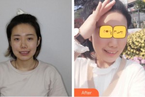 溫州醫(yī)科大學(xué)附屬口腔學(xué)院李鋒整形價(jià)格表附口腔矯正案例展示