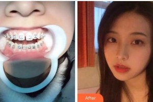 溫州醫(yī)科大學(xué)附屬口腔學(xué)院趙瑜整形價(jià)格表附隱形托槽矯正案例展示