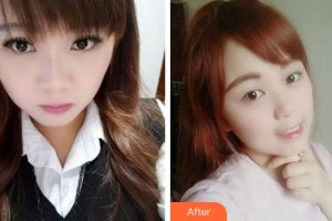 溫州王曉峰口腔醫(yī)院張麗莉整形價格表附牙齒隱形矯正案例展示