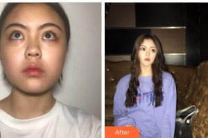 溫州明樂眼科醫(yī)院陳曉明整形價格表附內(nèi)切祛眼袋案例展示