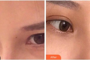 溫州明樂眼科醫(yī)院李連珠整形價格表附內(nèi)切祛眼袋案例展示