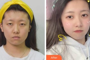 溫州明樂眼科醫(yī)院季娟娟整形價格表附眼部綜合案例展示