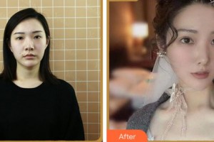 溫州醫(yī)科大學(xué)附屬眼視光醫(yī)院鄭斌整形價格表附眼部綜合案例展示