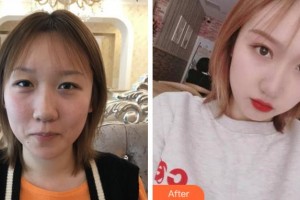 溫州醫(yī)科大學(xué)附屬眼視光醫(yī)院黃錦海整形價格表附切開雙眼皮案例展示