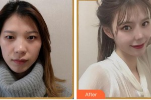 溫州醫(yī)科大學(xué)附屬眼視光醫(yī)院包芳軍整形價格表附眼部綜合案例展示