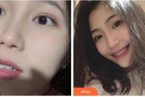 溫州華君美口腔門診部王光耀整形價格表附自鎖托槽矯正案例展示