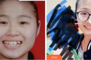 溫州藍(lán)芽口腔門診部趙微整形價格表附金屬托槽矯正案例展示