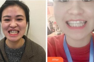 溫州牙博士口腔門診部魏謀達(dá)整形價格表附牙齒隱形矯正案例展示