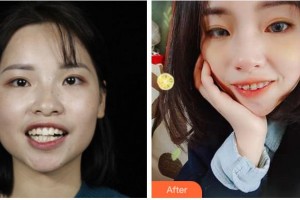 溫州牙博士口腔門診部呂昊昕整形價格表附金屬托槽矯正案例展示