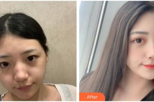 嘉興華山醫(yī)療美容醫(yī)院謝惠芬整形價格表附激光祛斑案例展示