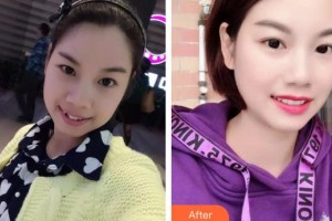 嘉興華山醫(yī)療美容醫(yī)院藍(lán)圓育整形價格表附金屬托槽矯正案例展示