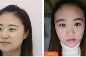 嘉興愛爾眼科醫(yī)院張文鳳整形價(jià)格表附眼部綜合案例展示